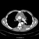 Stab wound of thorax, internal mammary artery and aortic arch, mediastinal hemorrhage, hemothorax: CT - Computed tomography